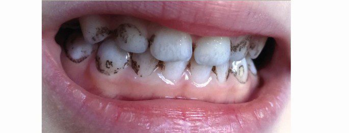 Black stain e macchie nere sui denti dei bambini